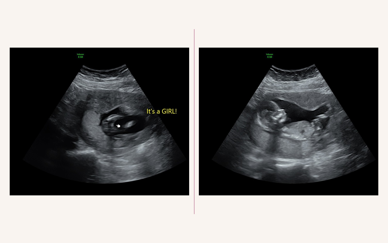 We're Having a Baby Girl: Luke's 14-Week Ultrasound Reaction (and My Boy-Mom Heart Melting) — illustration